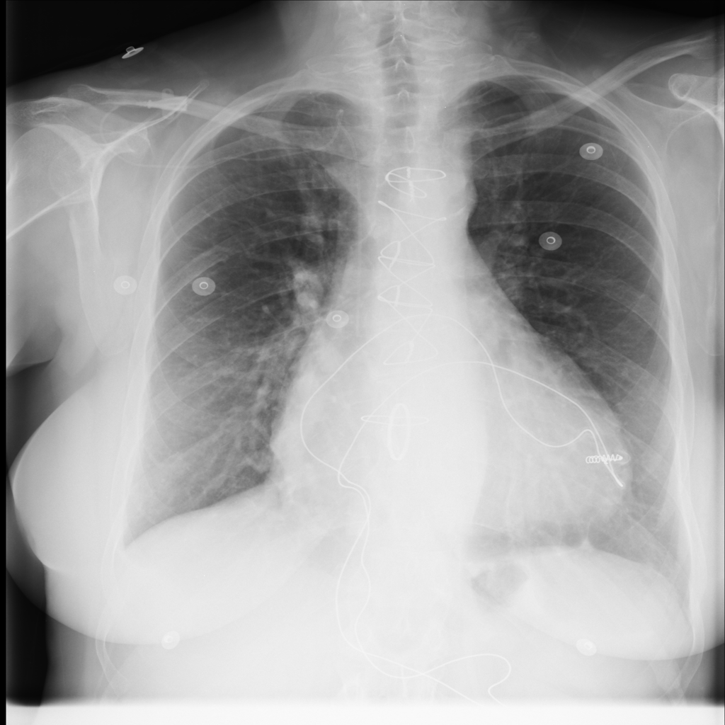 Cardiomegaly representative X-ray